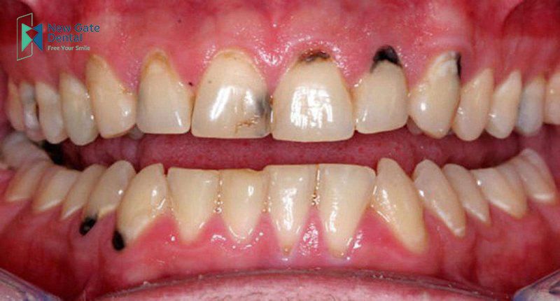 Răng cửa bị đen: Nguyên nhân và cách khắc phục hiệu quả