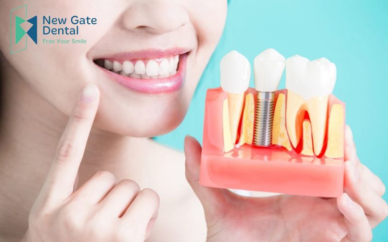 Cấy ghép implant giá rẻ, uy tín tại tphcm Trong-rang-implant-gia-re