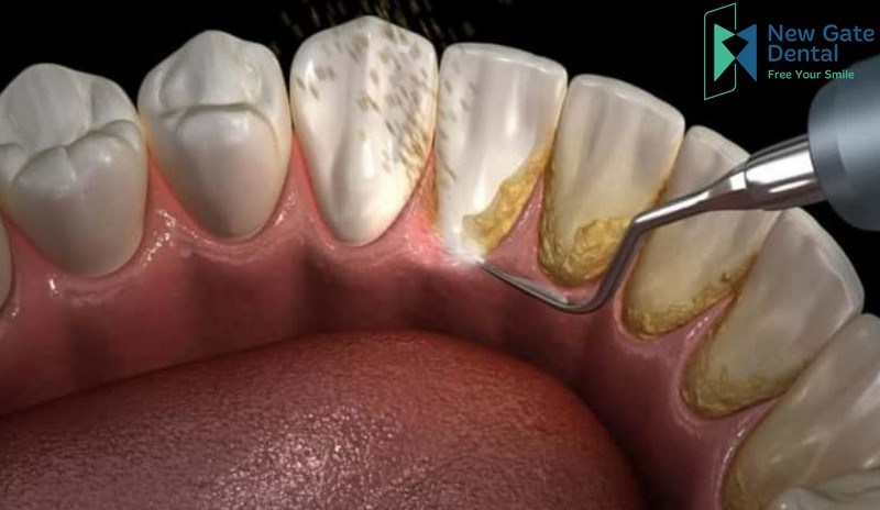 Chân răng bị đen: Nguyên nhân và cách điều trị
