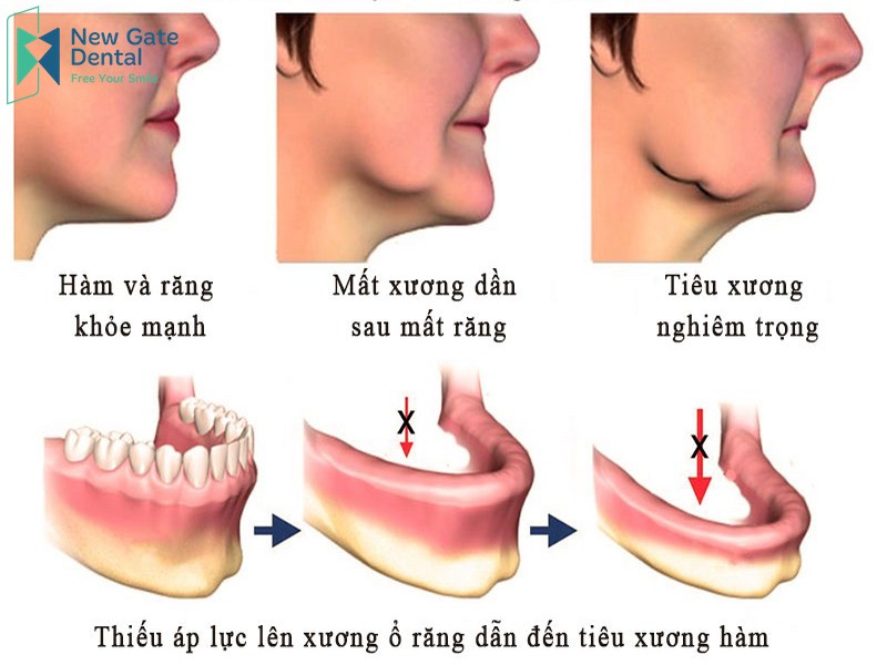 Răng sâu không nhổ có sao không? Rang-sau-khong-nho-co-sao-khong-3