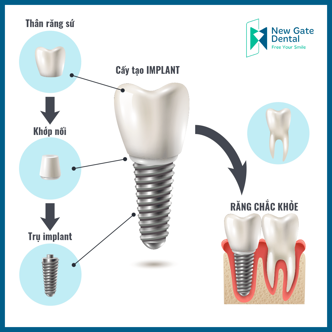 Chi phí trồng răng Implant