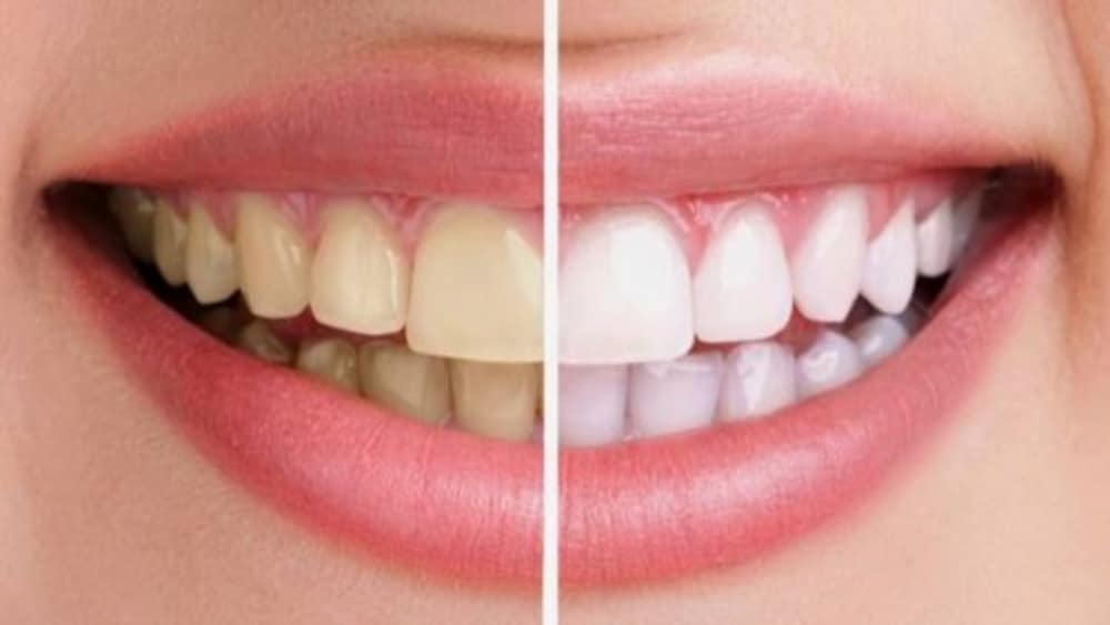 Tẩy trắng răng là gì