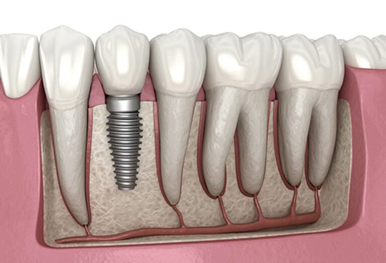 Trồng răng implant cho người bị tiểu đường