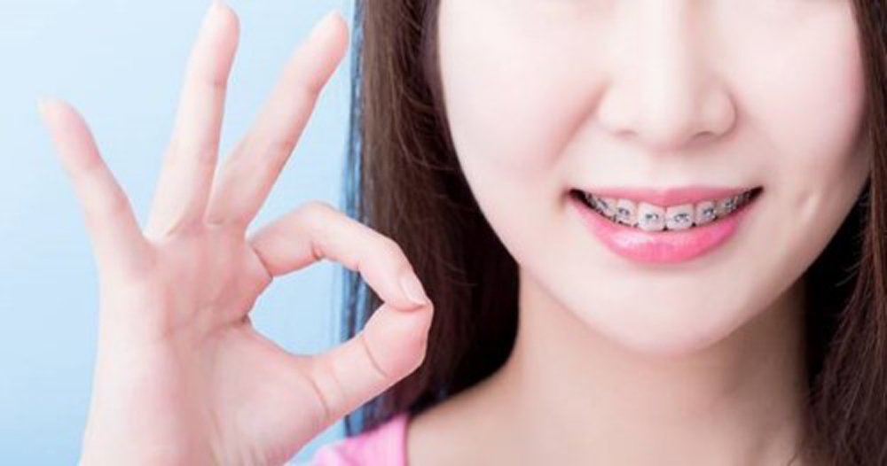 niềng răng chữa cười hở lợi
