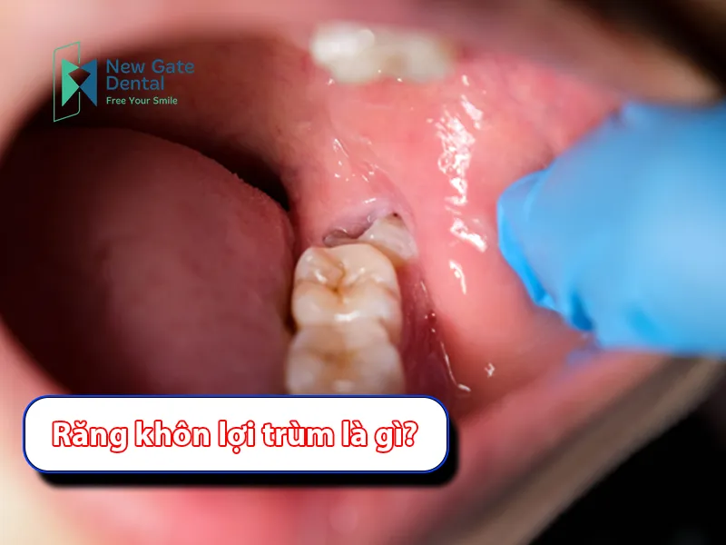 What is Pericoronitis?