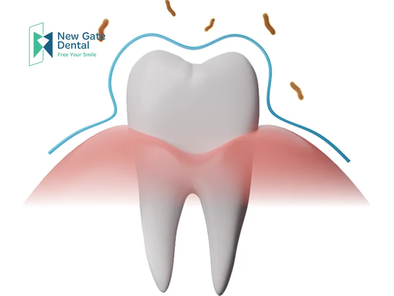 Causes of Pericoronitis