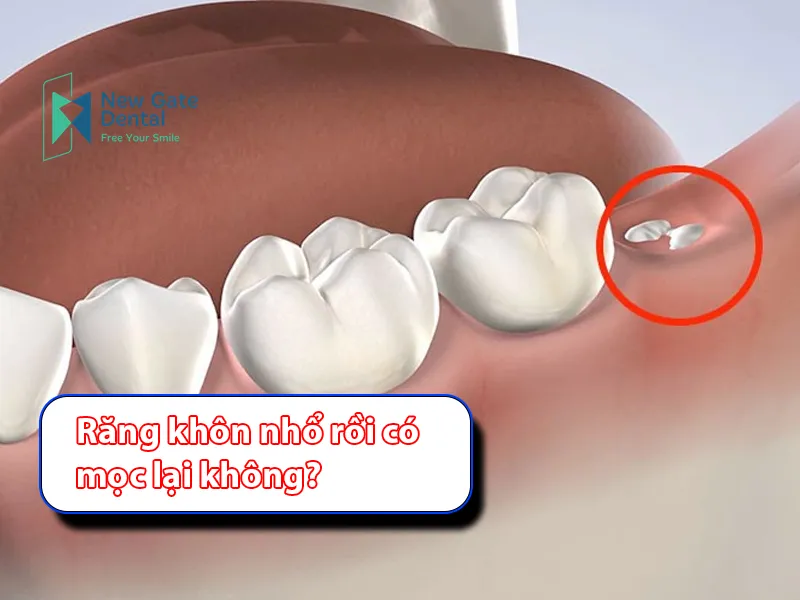 Will wisdom teeth grow back after extraction?