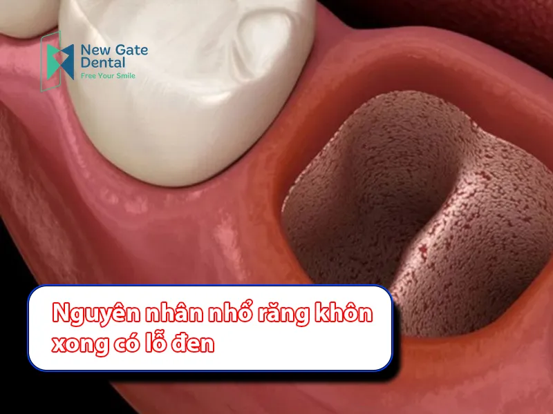 Causes of Holes After Wisdom Tooth Extraction