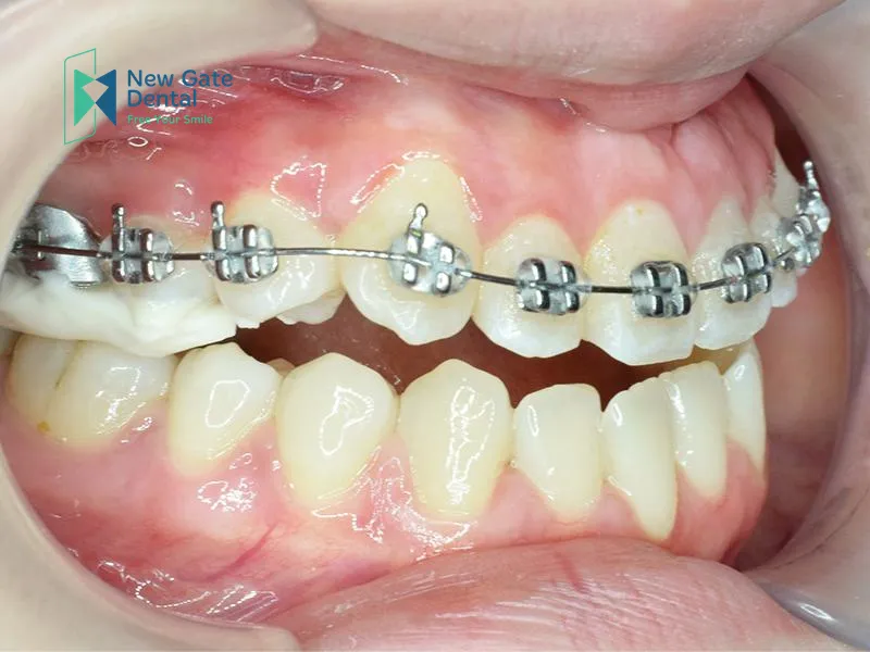 How Much Do Braces for One Arch Cost?