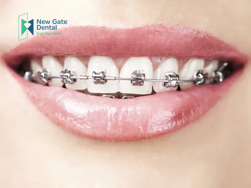 What is Fixed Braces?