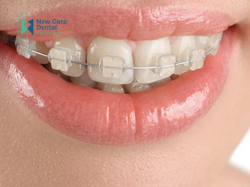 Types of Fixed Braces