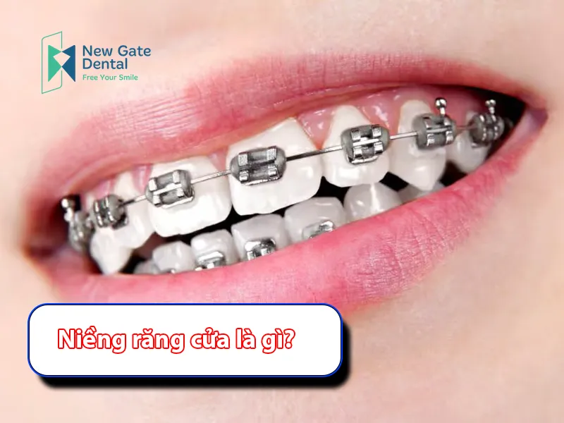 What Is Front Teeth Braces?