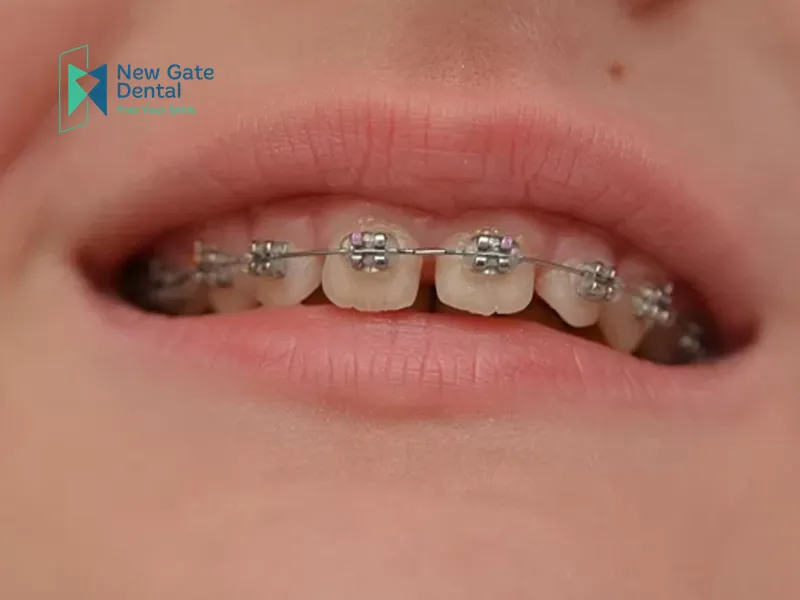 Types of Front Teeth Braces