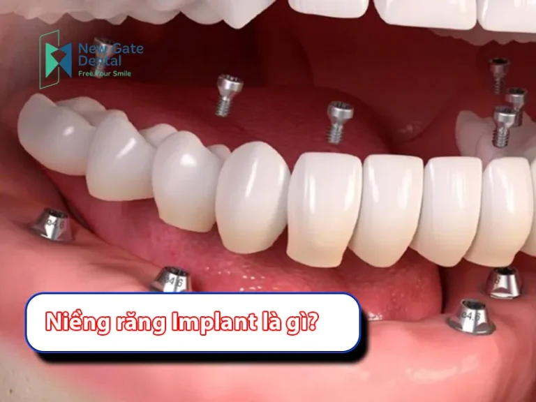 nieng-rang-implant