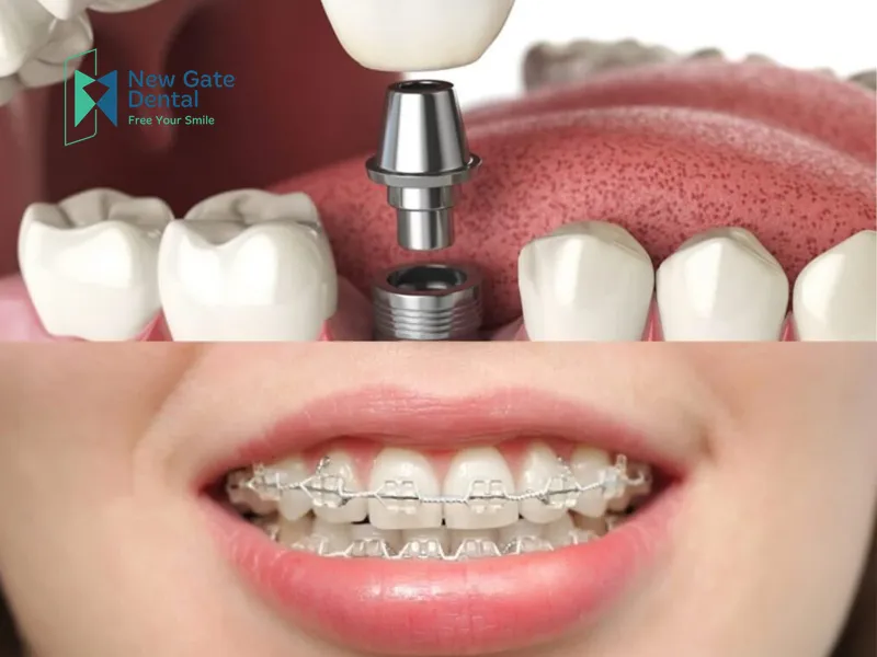 Should You Get Braces or Dental Implants First?