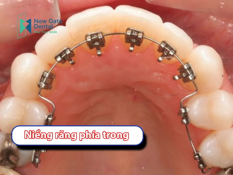 What Are Lingual Braces?