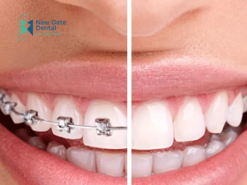 Why Are Costs Higher Than Traditional Braces?