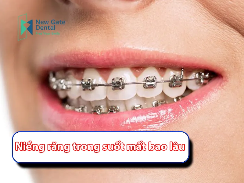 How Long Does Clear Braces Take?