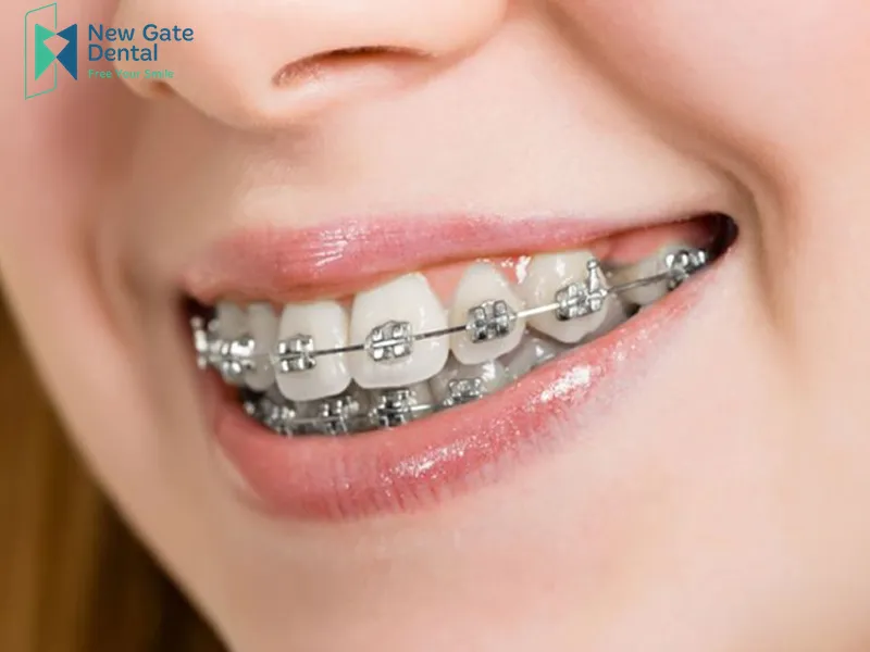 How Long Does Overbite Braces Take?