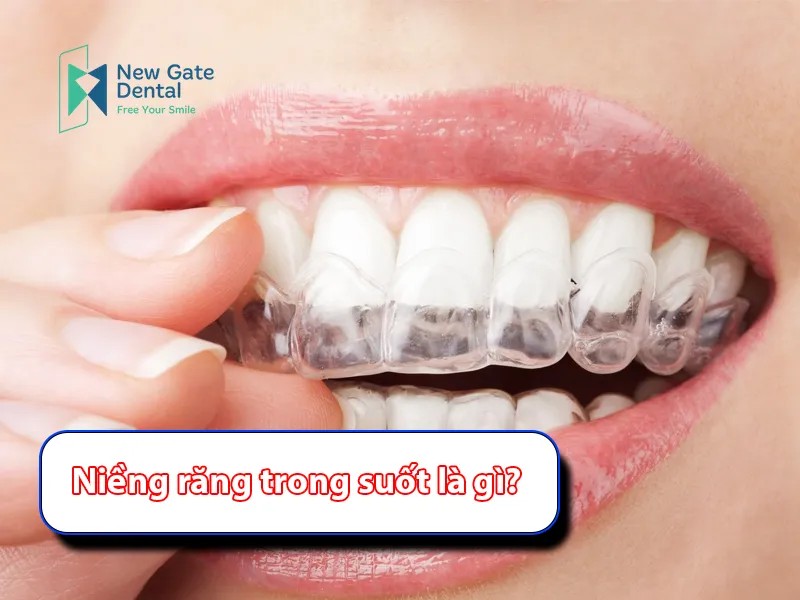 What Are Clear Aligners