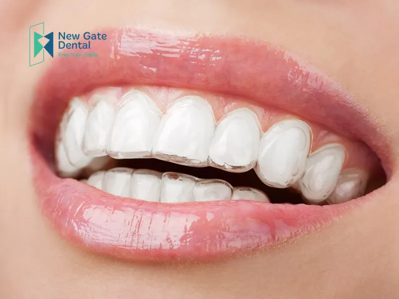 Invisalign Clear Aligners