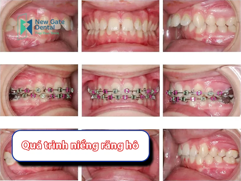 Buck Teeth Braces Process