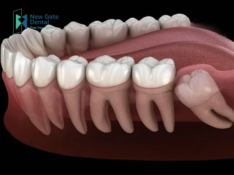 When to Extract Wisdom Teeth