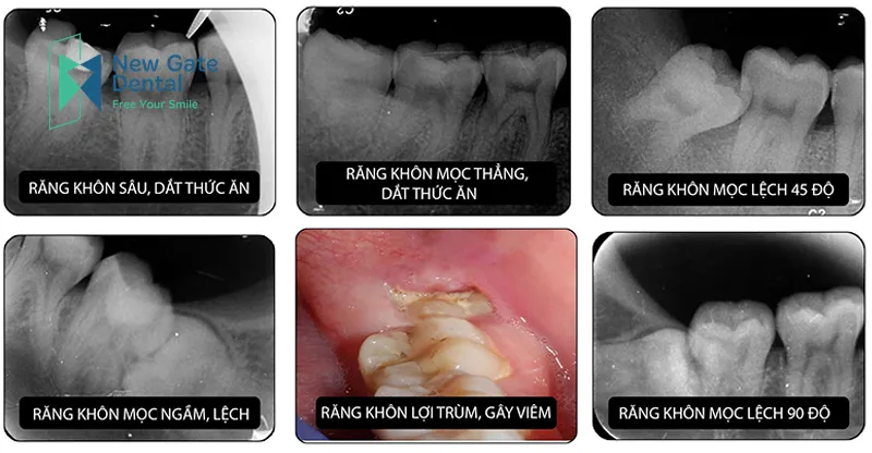 gia-nho-rang-khon-ham-duoi1