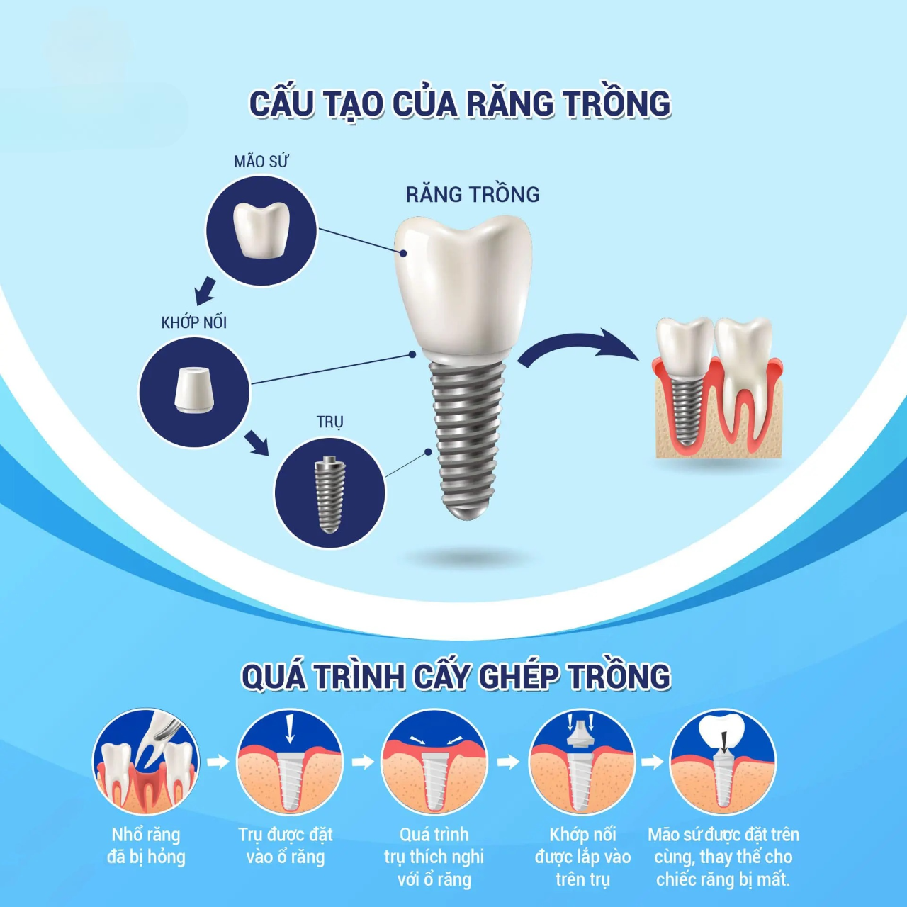 Quy trình Trồng răng implant cho răng cửa bị mất