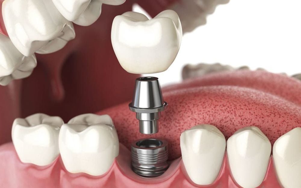 Trồng răng implant khi tiêu xương