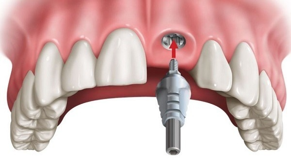 Trồng răng implant cho răng cửa bị mất