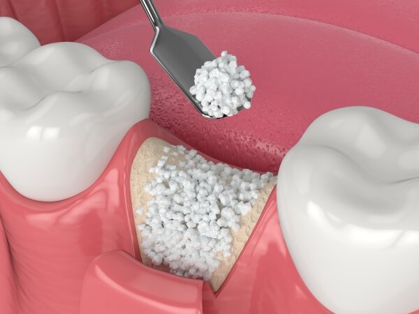 Trồng răng implant khi tiêu xương