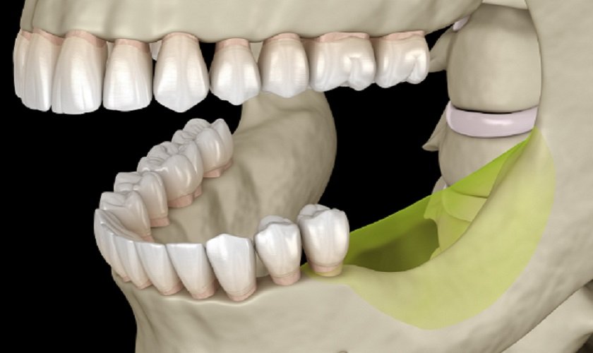 Trồng răng implant khi tiêu xương