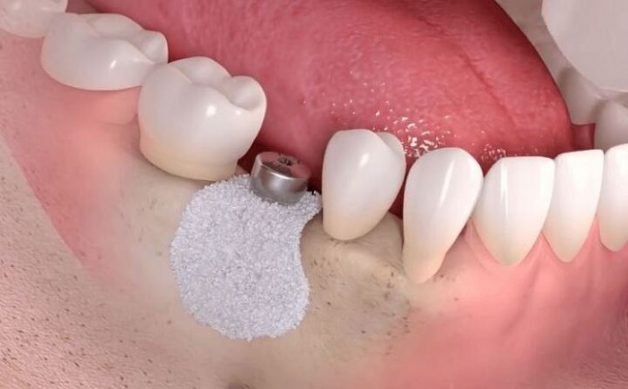 Trồng răng implant khi tiêu xương