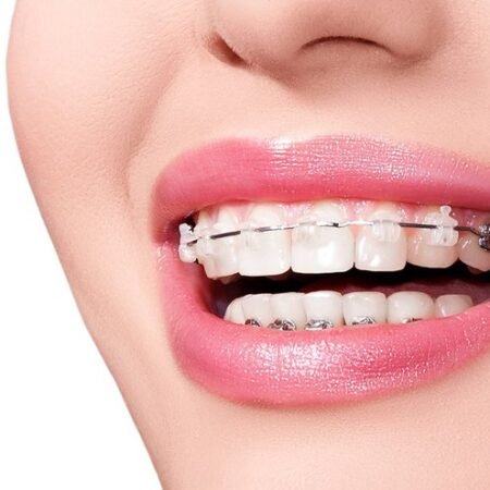 Niềng răng Mắc Cài Sứ