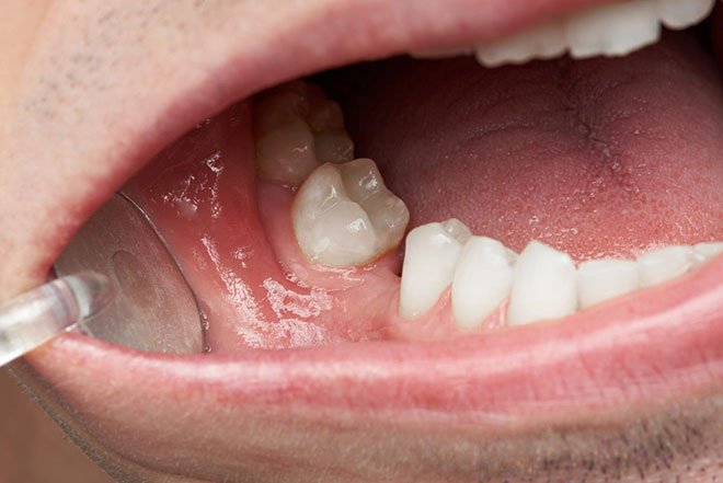 Trồng răng implant cho răng hàm bị mất