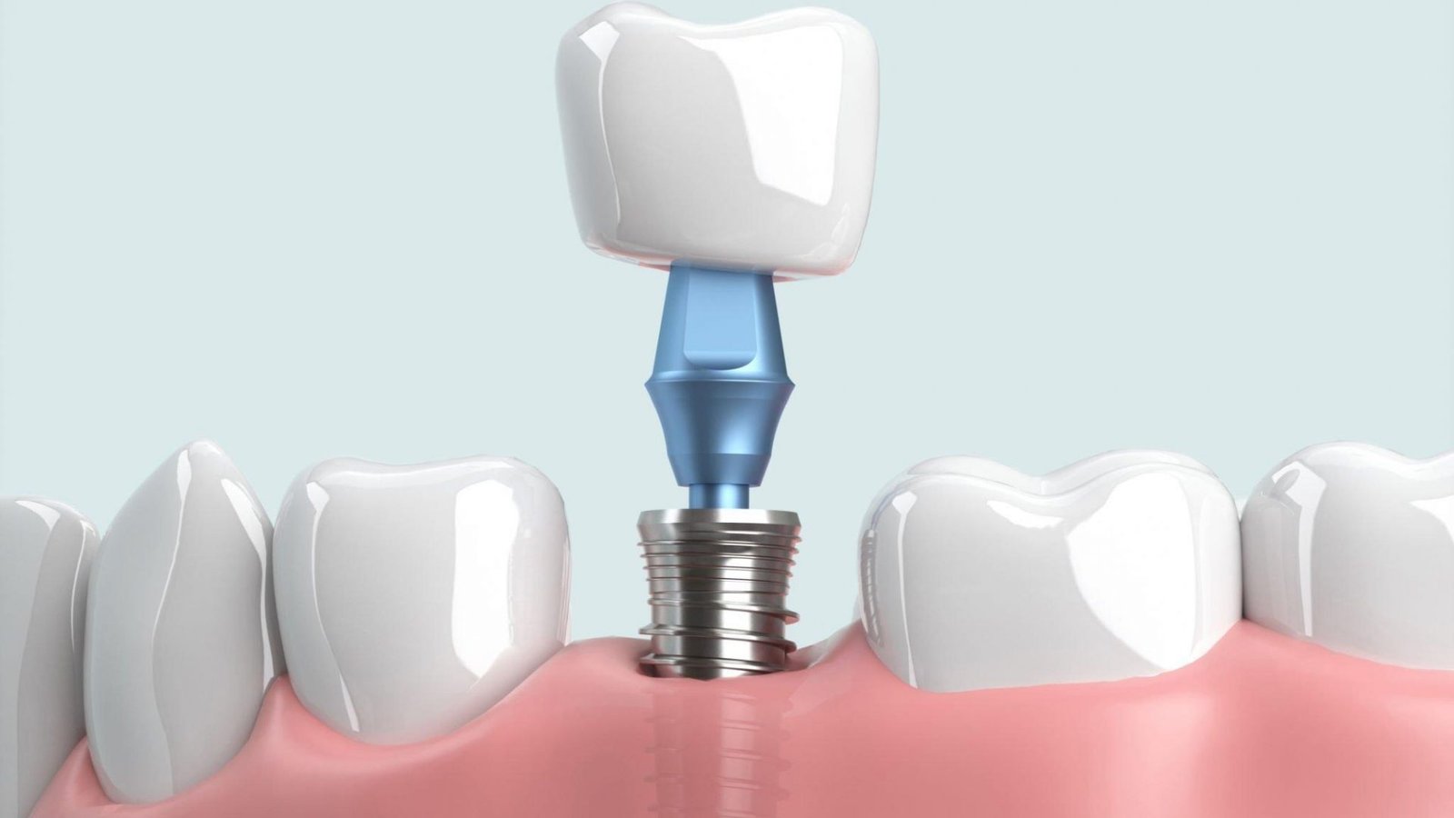 Trồng răng implant cho răng hàm bị mất
