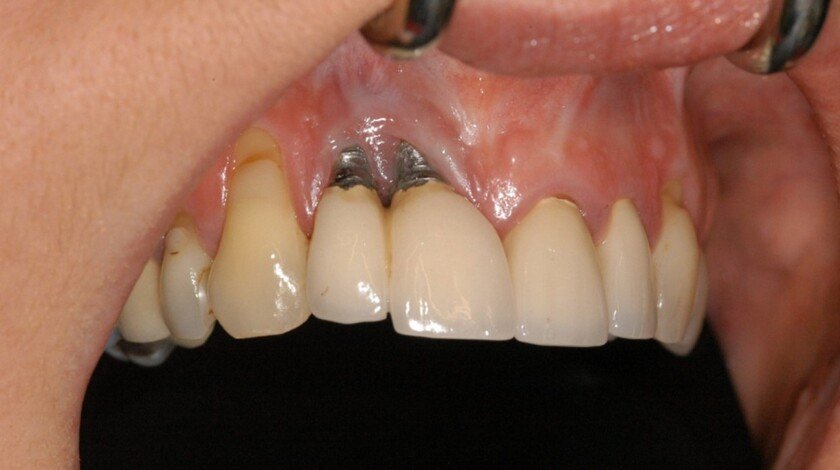 Biến chứng trồng răng implant