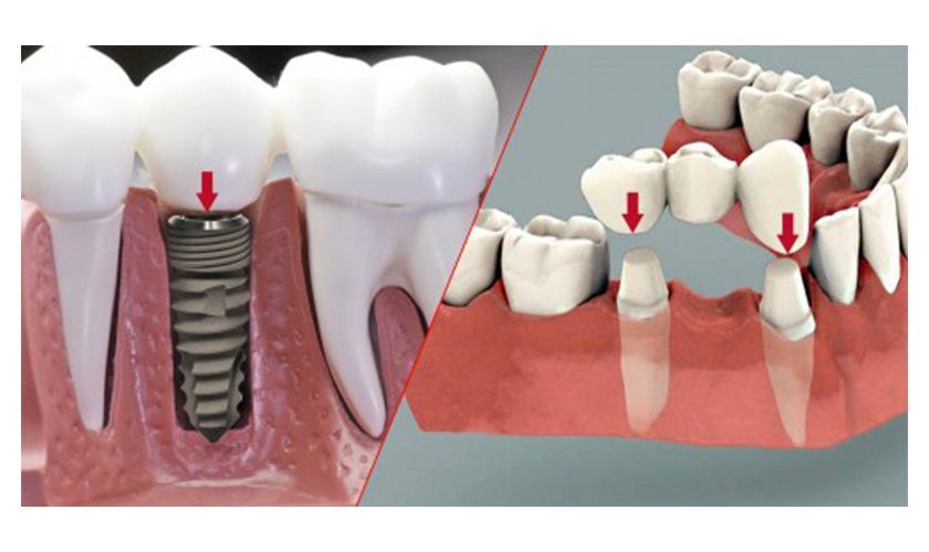 Trồng răng implant và cầu răng