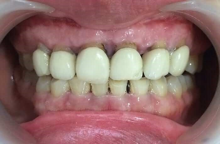 bọc răng sứ bị hở
