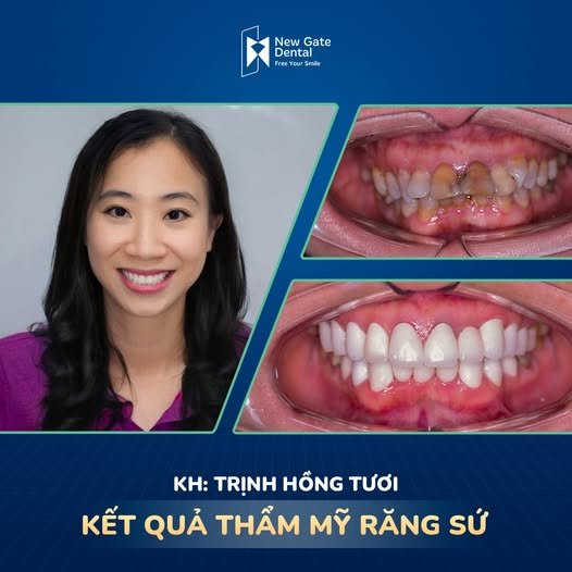 Khách hàng thẩm mỹ răng sứ