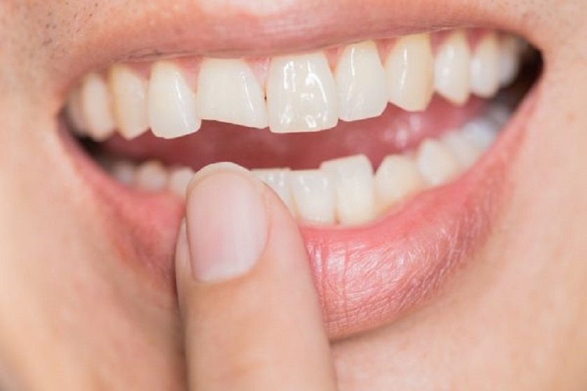 dấu hiệu nhân biết răng sứ hỏng