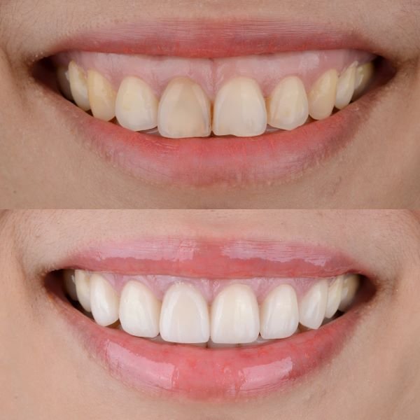 cười hở lợi là gì