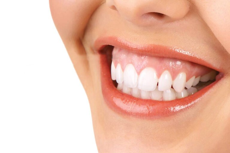 Cười hở nướu là gì