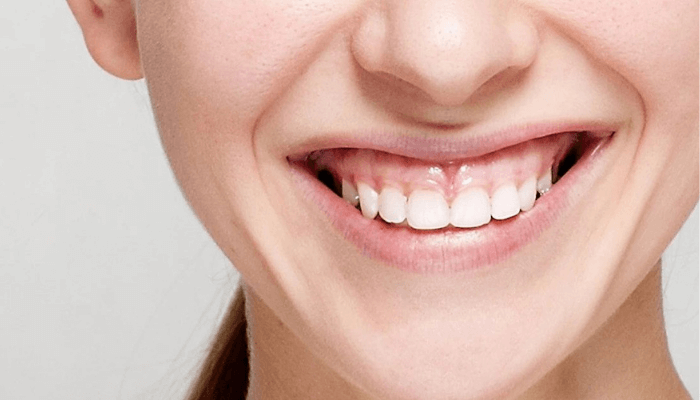điều trị cười hở lợi