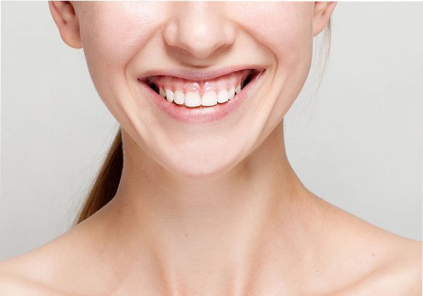 tác hại của cười hở lợi