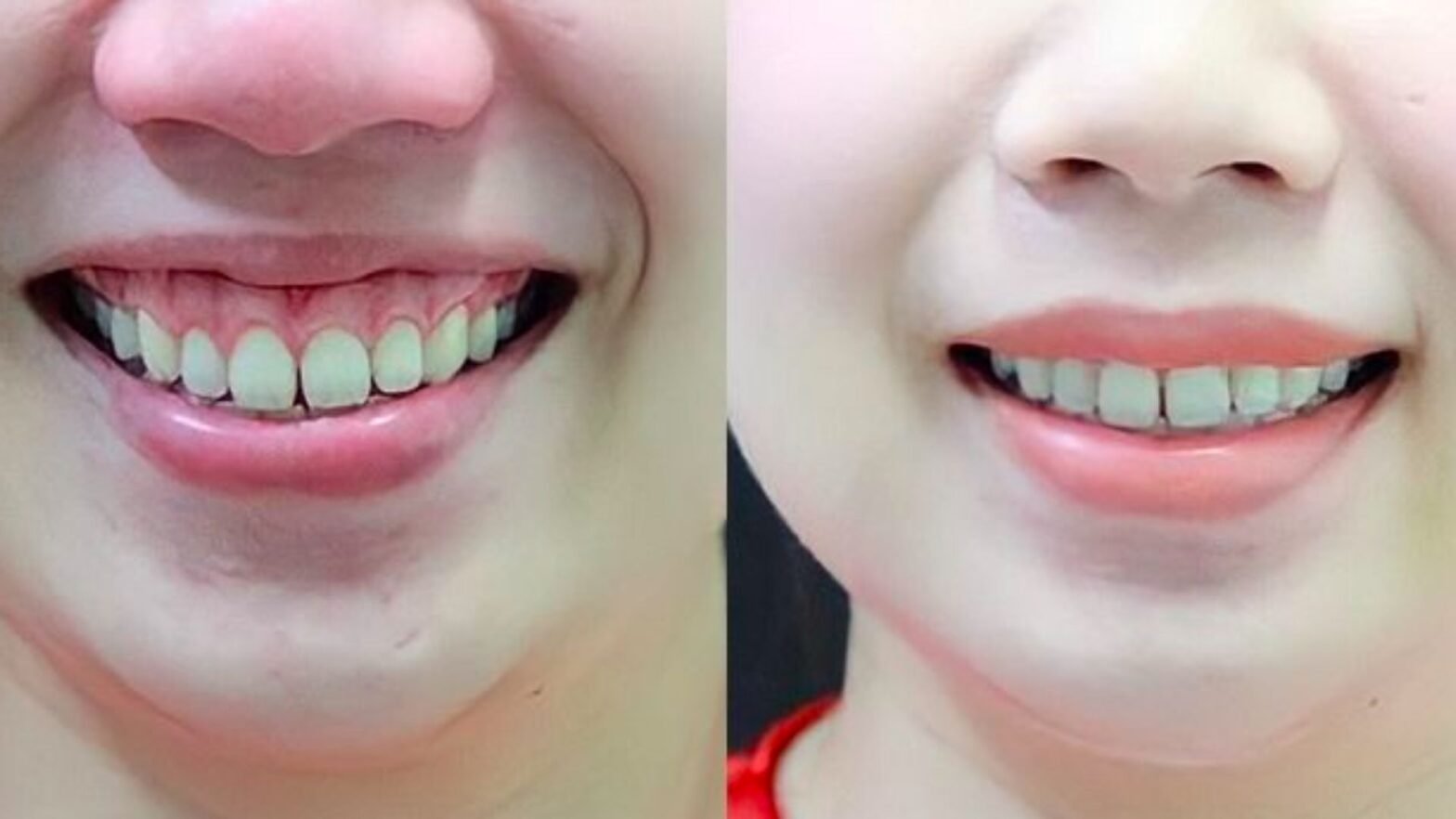 Chăm sóc sau khi điều trị cười hở lợi