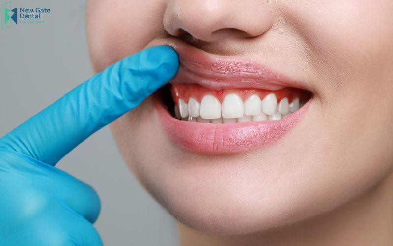 nguyên nhân gây tụt nướu