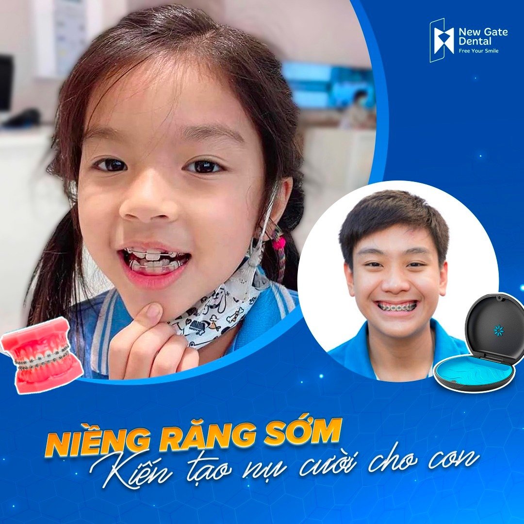 giá niềng răng cho trẻ em