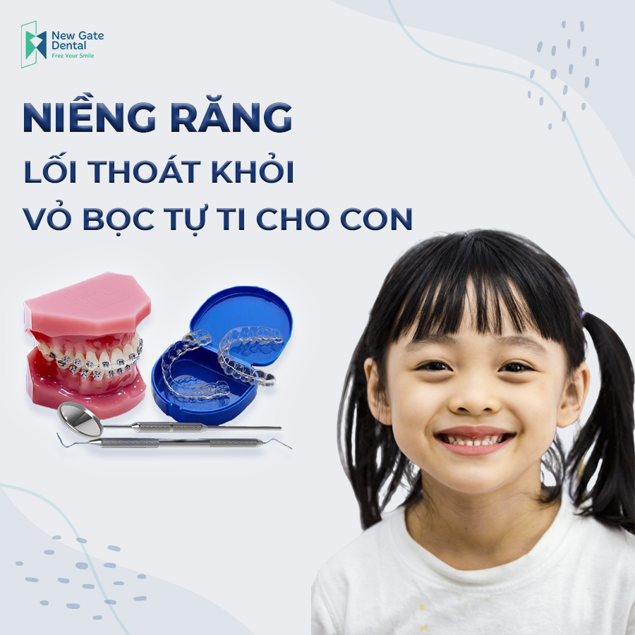 niềng răng cho trẻ em